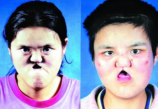 22岁女子脸部先天畸形近十次手术换面孔