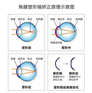 【家长必看】控制孩子近视利器:角膜塑形镜!