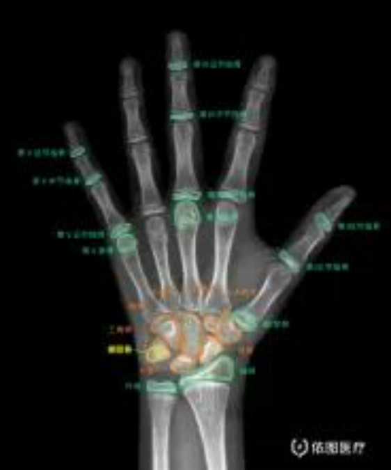 掌骨5块,指骨14块,加上尺,桡骨远端共29块,此外,拇指内侧籽骨也是骨骼