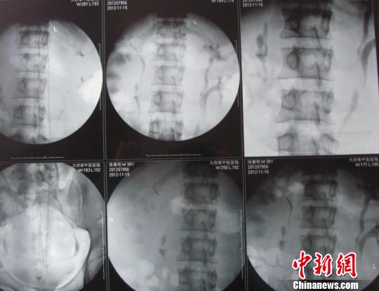 湖北一男子长罕见“四颗肾”称“并无压力”