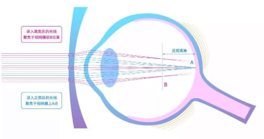 多區正向光學離焦鏡片的近視離焦效果圖